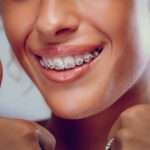 Clear Aligners