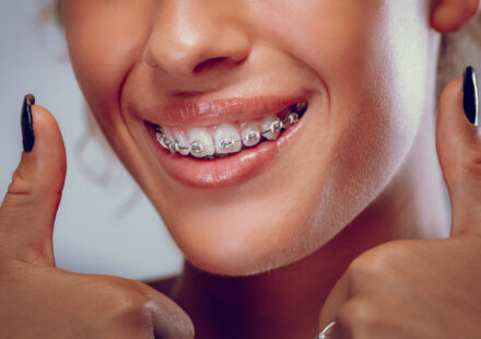 Clear Aligners