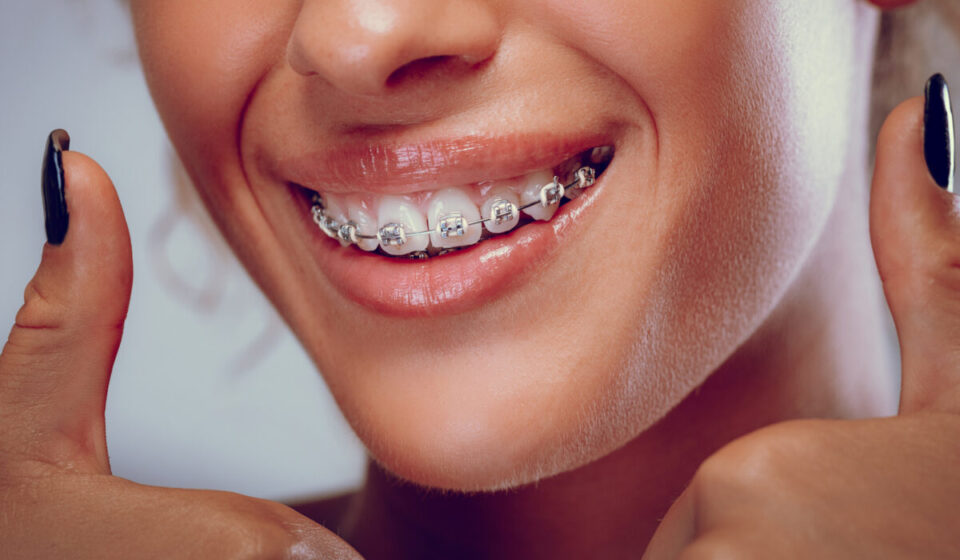 Clear Aligners