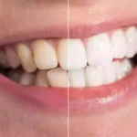 How to Get Rid of Sudden Brown Stains on Teeth Fast