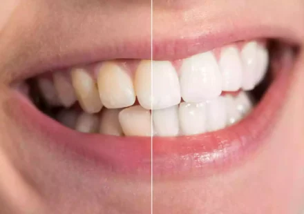 How to Get Rid of Sudden Brown Stains on Teeth Fast