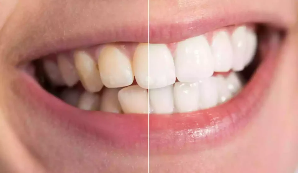 How to Get Rid of Sudden Brown Stains on Teeth Fast