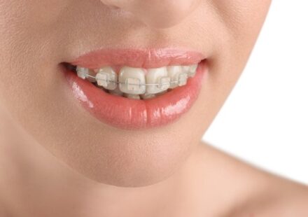 Ceramic Braces