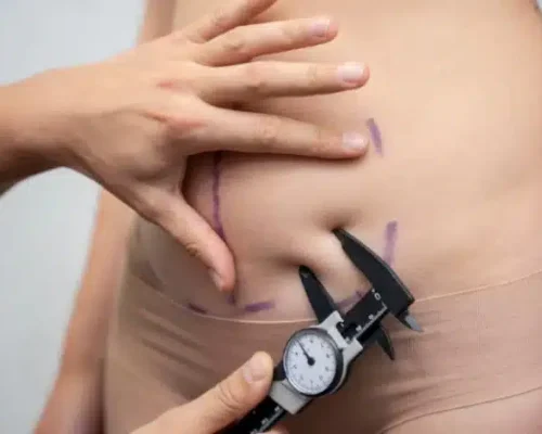 tummy tuck in lahore