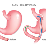 Gastric bypass surgery in Delhi