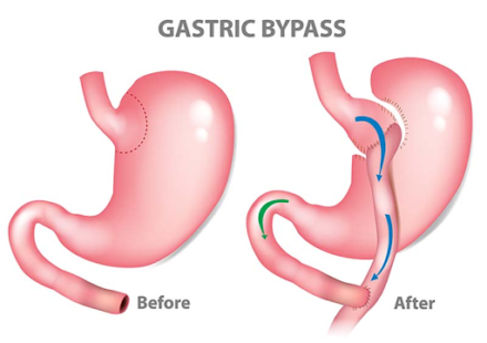 Gastric bypass surgery in Delhi