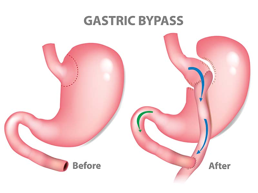 Gastric bypass surgery in Delhi
