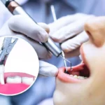 Tooth Extraction