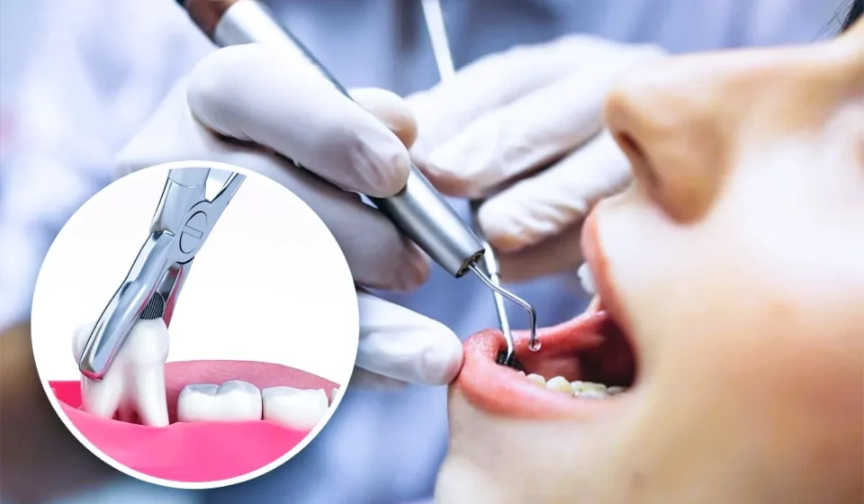 Tooth Extraction