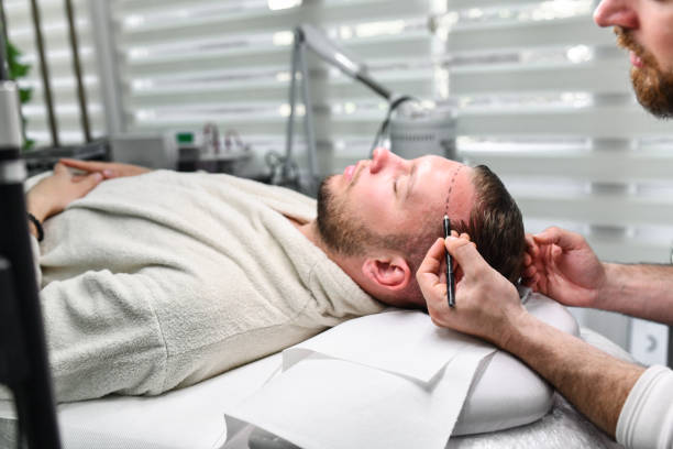 Hair Transplant in Riyadh