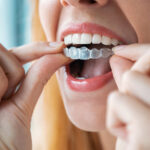 Aligner