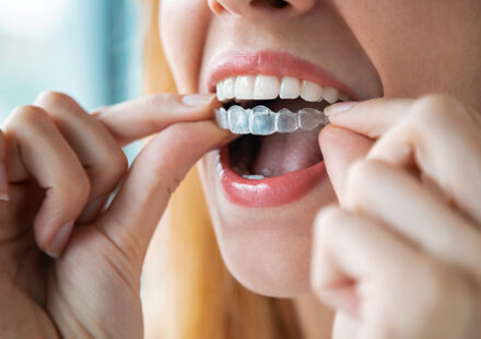Aligner