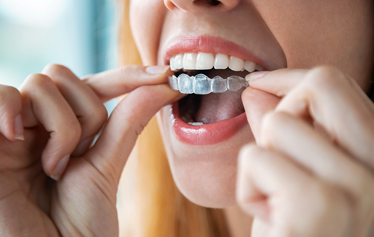 Aligner
