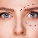 Chirurgie des paupières supérieures à Paris
