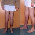 Osteomyelitis Treatment options for bone infection recovery