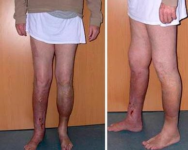 Osteomyelitis Treatment options for bone infection recovery
