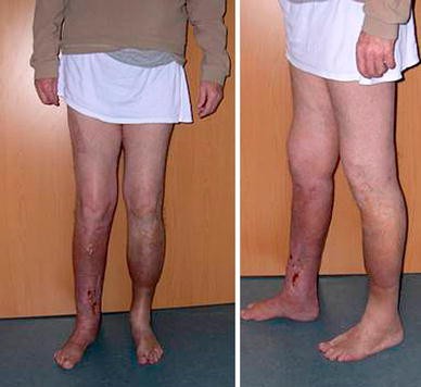Osteomyelitis Treatment options for bone infection recovery