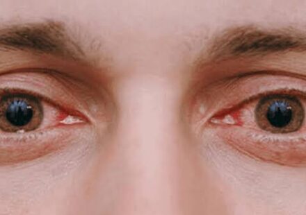 eye test at home in gurgaon