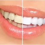 teeth whitening dubai