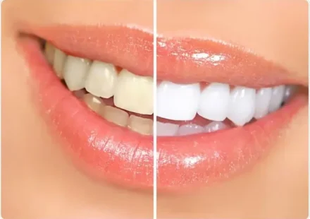 teeth whitening dubai