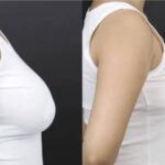 Breast