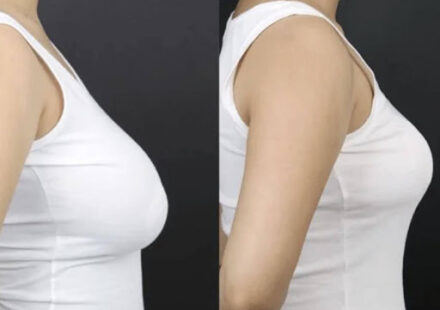 Breast