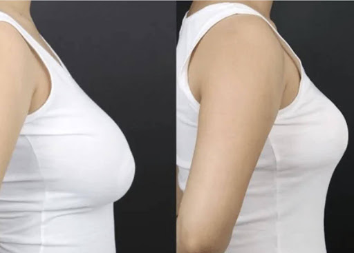 Breast